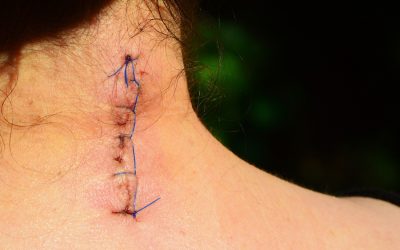 Narben, Spuren unseres Lebens